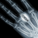 Una radiografía de una mano humana que revela un pequeño y complejo objeto metálico alojado cerca del hueso, la "pistola humeante" de la evidencia de implantes extraterrestres.