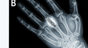 Una radiografía de una mano humana que revela un pequeño y complejo objeto metálico alojado cerca del hueso, la "pistola humeante" de la evidencia de implantes extraterrestres.